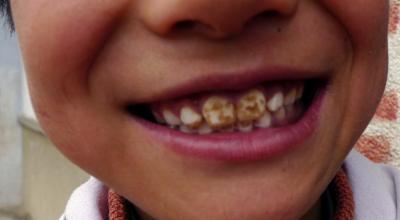 Флюороз зубов: профилактика и лечение у детей и взрослых Флюороз дырка в зубе
